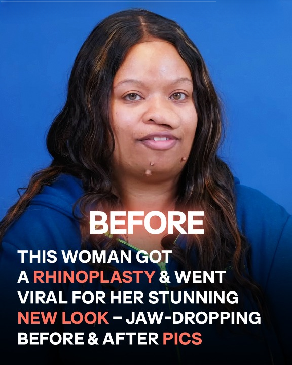 She Overcame Childhood Facial Tumors & Post-Surgery, Her Transformation Stuns Online – 5 More Uplifting Cosmetic Stories