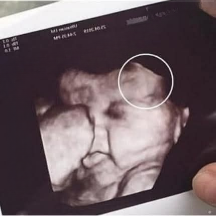 Doctors Couldn’t Believe What They Saw During the Ultrasound